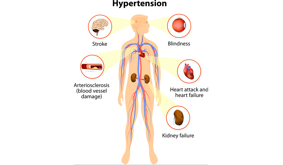 Hypertension