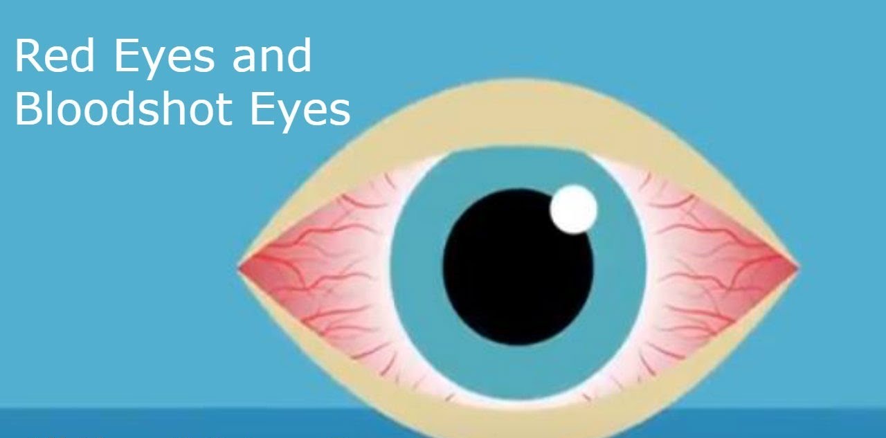 Red Eyes and Bloodshot Eyes